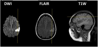 Visual and Imagery Magnitude Comparisons Are Affected Following Left Parietal Lesion